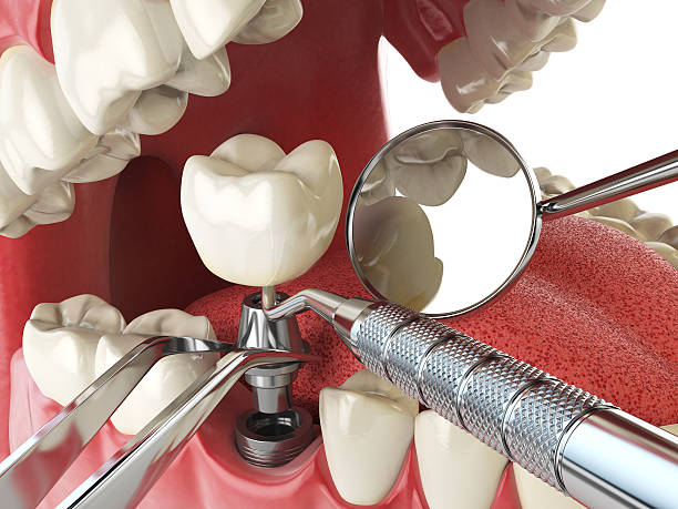 Best Emergency Tooth Extraction in Herndon, VA